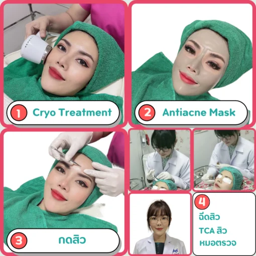 รายละเอียดคอร์สรักษาสิว Acne Care ระดับ 3 เลเซอร์รักษาสิวและรอยสิวจัดเต็ม