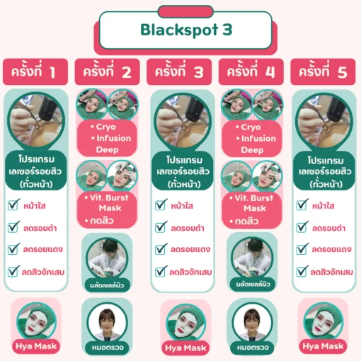 ขั้นตอนการรักษารอยสิวด้วยเลเซอร์ 5 ครั้ง โปรแกรม Blackspot 3 วรวลัญช์ คลินิก โคราช