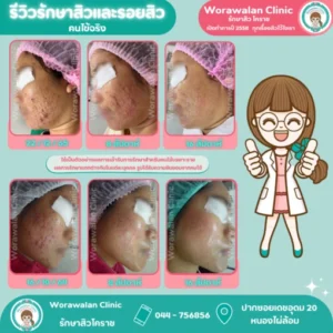 รีวิวรักษาสิวโดยหมอเจี๊ยบ วรวลัญช์ คลินิก เคสที่ 6