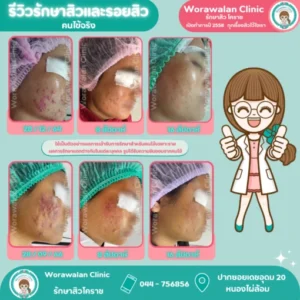 รีวิวรักษาสิวและรอยสิว โคราช วรวลัญช์ คลินิก เคสที่ 1