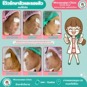 ผลลัพธ์การรักษาสิวอุดตันและรอยดำ โคราช เคสที่ 2