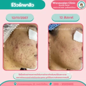 รีวิวรักษาสิวที่หลัง รอยสิวที่หลัง โคราช เคสที่ 10