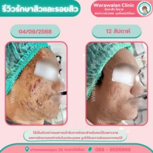 รีวิวเลเซอร์ลดรอยแดงสิว โคราช เคสที่ 11 วรวลัญช์ คลินิก