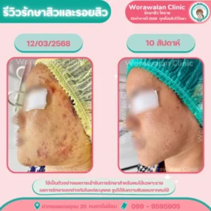 รีวิวเลเซอร์ลดรอยดำสิว หน้าใส โคราช เคสที่ 12