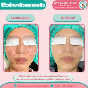 รีวิวหน้าใสด้วย IPL Cellec V โคราช เคสที่ 13