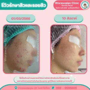 รีวิวรักษาแผลเป็นจากสิว โคราช เคสที่ 14 วรวลัญช์ คลินิก