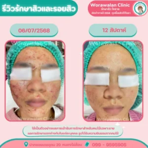 รีวิวหน้าใสไร้รอยสิว โคราช เคสที่ 15 วรวลัญช์ คลินิก