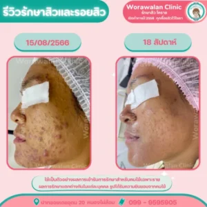 รีวิวรักษาหลุมสิว เลเซอร์ โคราช เคสที่ 16 วรวลัญช์ คลินิก