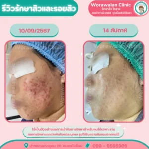 รีวิวเลเซอร์หลุมสิว เห็นผลชัดเจน โคราช เคสที่ 17