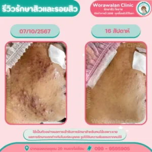 รีวิวเลเซอร์กระชับรูขุมขน โคราช เคสที่ 18 วรวลัญช์ คลินิก