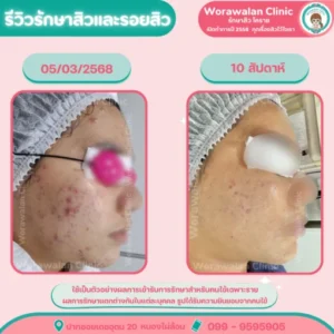 รีวิวปรับสภาพผิวหน้าเรียบเนียน โคราช เคสที่ 19