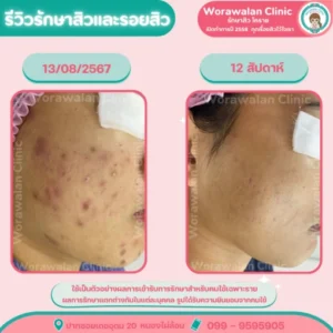 รีวิวรักษาสิวและผิวขรุขระ โคราช เคสที่ 20 วรวลัญช์ คลินิก