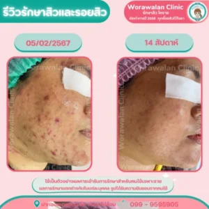 รีวิวรักษาสิวสเตียรอยด์ สิวติดสาร โคราช เคสที่ 21