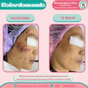 รีวิวรักษาสิวผิวแพ้ง่าย โคราช เคสที่ 22 วรวลัญช์ คลินิก
