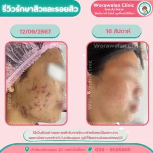 รีวิวรักษาสิวเรื้อรัง เป็นๆ หายๆ โคราช เคสที่ 23