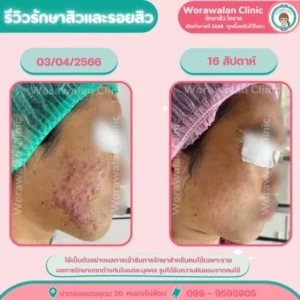 รีวิวสร้างเกราะป้องกันผิวหลังรักษาสิว โคราช เคสที่ 25