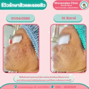 รีวิวรักษาสิวเห็นผลไว 4 สัปดาห์ โคราช เคสที่ 26