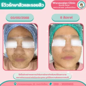 รีวิวรักษาสิว 8 สัปดาห์ หน้าใสขึ้น โคราช เคสที่ 27