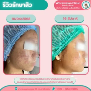 รีวิวรักษาสิว 12 สัปดาห์ จบคอร์สหน้าใส โคราช เคสที่ 28