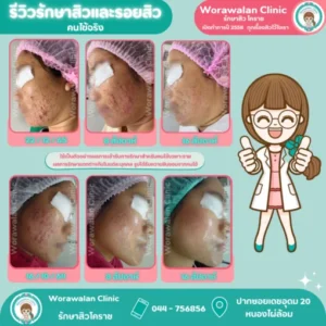 รีวิวรักษาสิว 16 สัปดาห์ เคสสิวรุนแรง โคราช เคสที่ 29