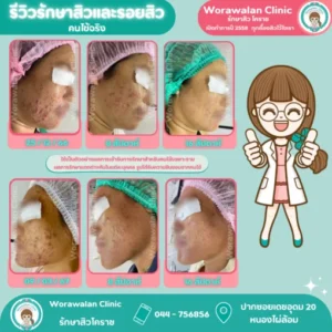 วิวรักษาสิวกับหมอเจี๊ยบ โคราช เคสที่ 31 วรวลัญช์ คลินิก