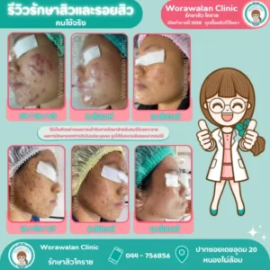 รีวิวรักษาสิวราคาคุ้มค่า โคราช เคสที่ 33 วรวลัญช์ คลินิก