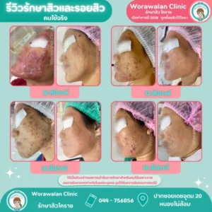 รีวิวรักษาสิวที่ไหนดี โคราช เคสที่ 35 วรวลัญช์ คลินิก