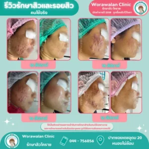 รีวิวผลลัพธ์สุดท้ายหน้าใสไร้สิว โคราช เคสที่ 36