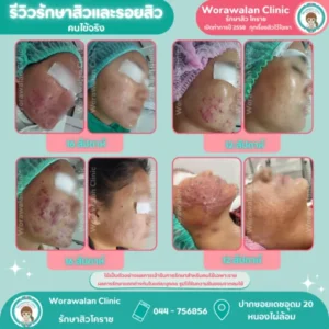 รีวิวรักษาสิวลูกค้าประทับใจ โคราช เคสที่ 37 วรวลัญช์ คลินิก