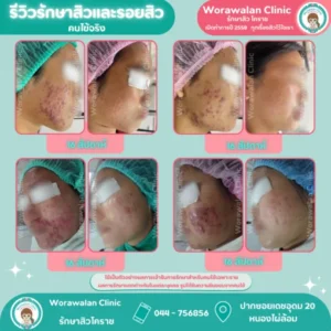 รีวิวรักษาสิว โคราช เคสที่ 38 ที่สุดความประทับใจ