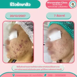รีวิวรักษาสิวอุดตัน กดสิว โคราช เคสที่ 4 วรวลัญช์ คลินิก