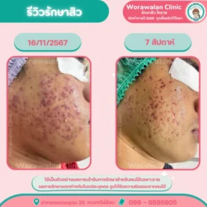 รีวิวหน้าใส ลดรอยดำสิว โคราช เคสที่ 5 วรวลัญช์ คลินิก