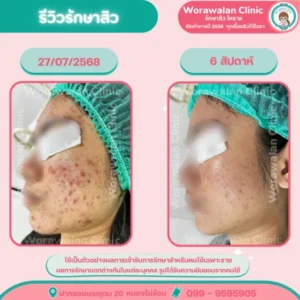 รีวิวรักษาสิวอักเสบแดง โคราช เคสที่ 6 วรวลัญช์ คลินิก