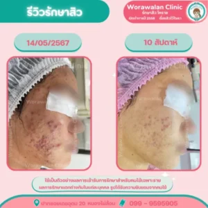 รีวิวรักษาสิวหัวช้าง สิวเม็ดใหญ่ โคราช เคสที่ 7