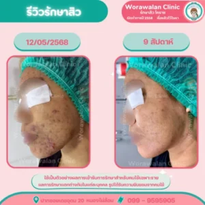 รีวิวกดสิวอุดตันละเอียด โคราช เคสที่ 8 วรวลัญช์ คลินิก