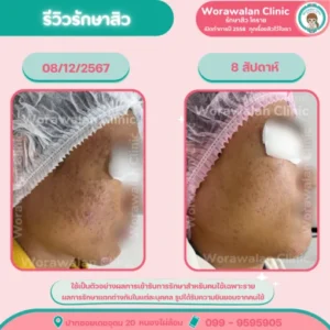 รีวิวรักษาสิวฮอร์โมน คางและกรอบหน้า โคราช เคสที่ 9