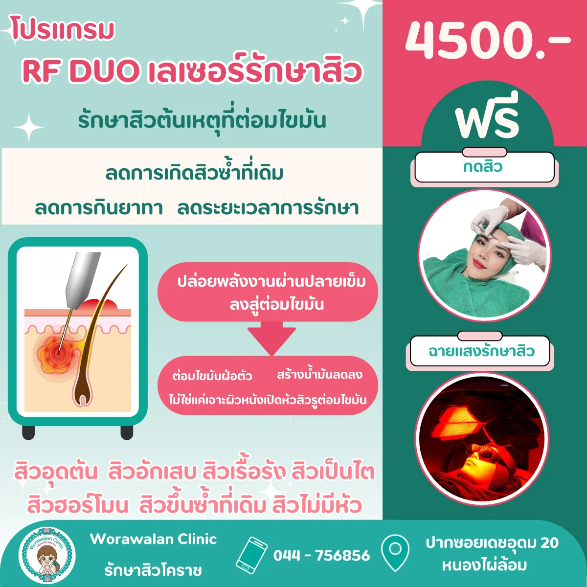 รักษาสิว โคราช โปรแกรม RF DUO เลเซอร์รักษาสิวที่ต้นเหตุต่อมไขมัน ราคา 4500 บาท วรวลัญช์ คลินิก