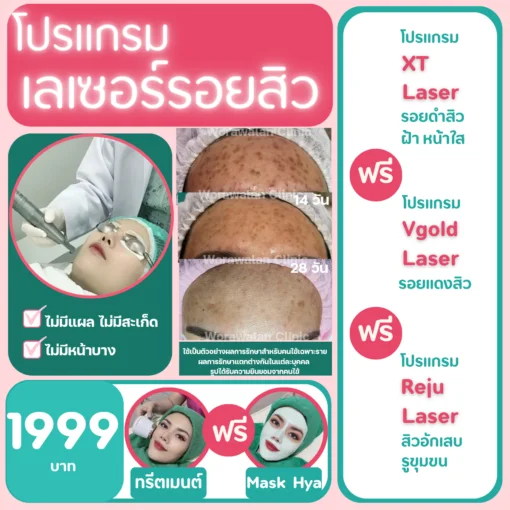โปรโมชั่นทดลองเลเซอร์รอยสิว โคราช ราคา 1,999 บาท XT Laser, Vgold, Reju วรวลัญช์ คลินิก