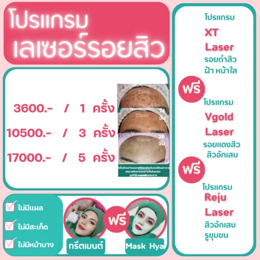 คอร์สเลเซอร์รอยสิว โคราช ราคา 1 ครั้ง 3 ครั้ง และ 5 ครั้ง วรวลัญช์ คลินิก