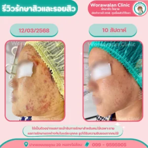 รีวิวรักษาสิวสเตียรอยด์ โคราช วรวลัญช์ คลินิก เดชอุดม 20