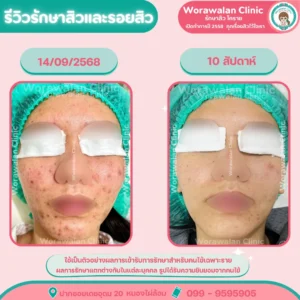 รีวิวรักษาสิวและรอยสิวโคราช แก้ปัญหาสิวฮอร์โมนวัยรุ่น