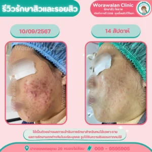 รีวิวรักษาสิวอุดตัน โคราช หมอเจี๊ยบ วรวลัญช์ คลินิก