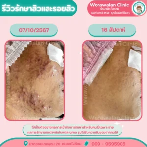 รีวิวเลเซอร์ลดรอยแดงสิว โคราช หน้าใสสม่ำเสมอจริง