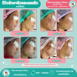รีวิวเลเซอร์รอยสิว โคราช หนองไผ่ล้อม หน้าใสไร้รอยแดง