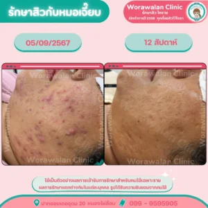 รีวิวรักษาเฉพาะสิว โคราช วรวลัญช์ คลินิก ปรึกษาฟรี