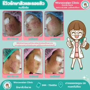 รีวิวรักษาผิวและรอยสิว โคราช หนองไผ่ล้อม รอยแดงรอยดำจางลงชัดเจน