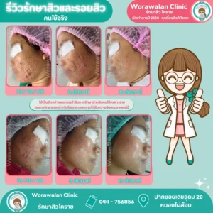 เคสรีวิวคนไข้จริง รักษาสิวอุดตันและสิวสเตียรอยด์ วรวลัญช์ คลินิก โคราช