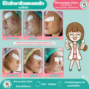 รีวิวรักษาผิวและรอยสิว โคราช หนองไผ่ล้อม รอยแดงรอยดำจางลงชัดเจน