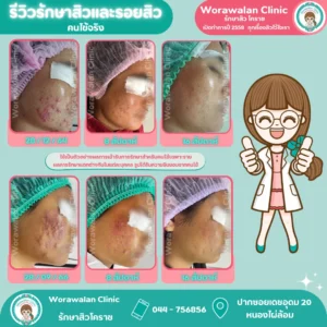 เคสรีวิวคนไข้จริง รักษาสิวอุดตันและสิวสเตียรอยด์ วรวลัญช์ คลินิก โคราช