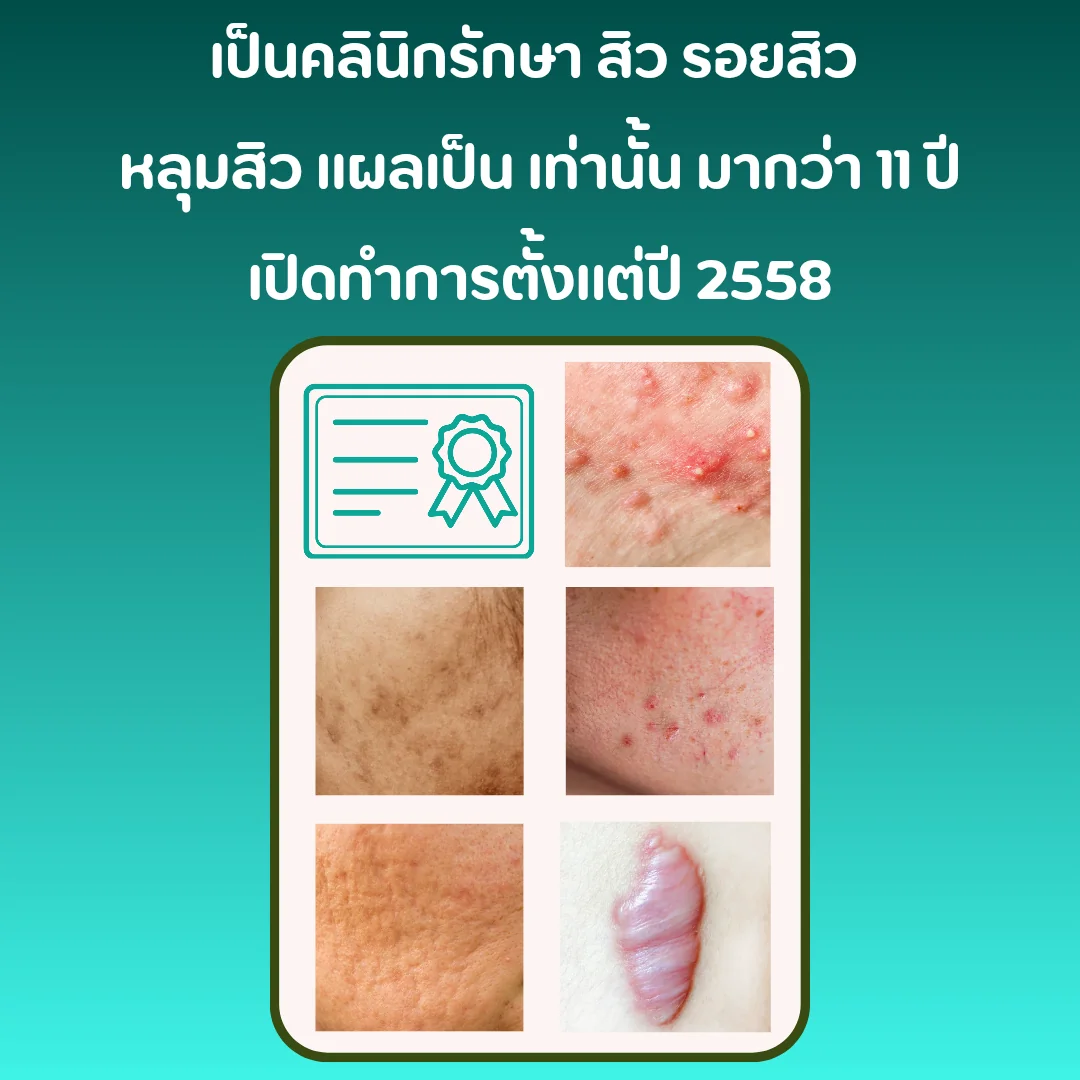 คลินิกรักษาสิวโคราช รักษาปัญหาสิว รอยสิว หลุมสิว แผลเป็น วรวลัญช์ คลินิก